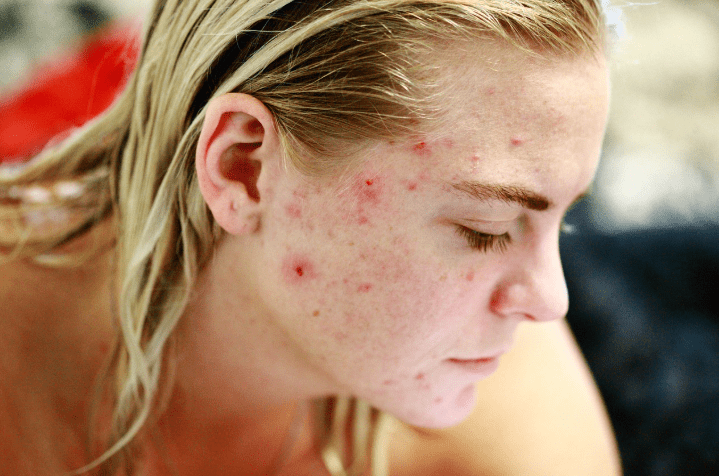 Acne Scar Removal Portland - Laser Surgery Oregon